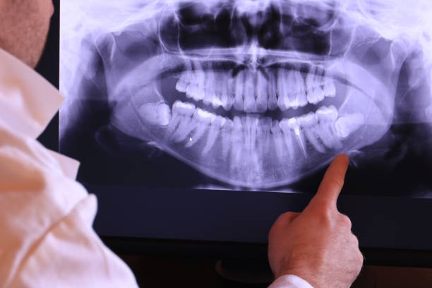 Best Emergency Wisdom Tooth Extraction in Fairplay, GA