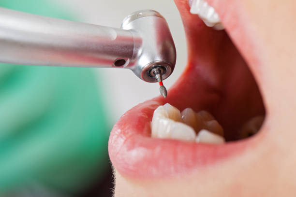 Best Knocked-Out Tooth (Avulsed Tooth) Treatment in Fairplay, GA